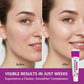 Crema per l'acne con acido azelaico al 12% (20 ml)